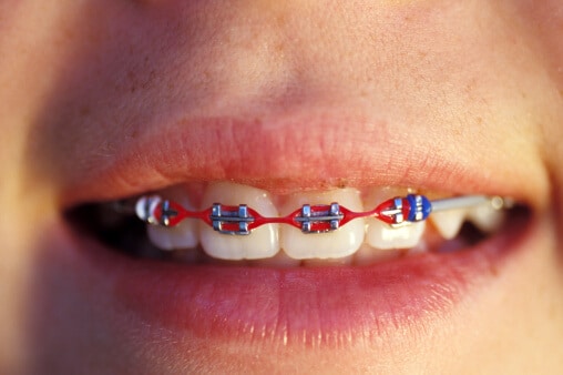what do rubber bands do for braces